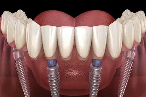 All On 4 Dental Implants And Personal Protective Equipment: Ensuring A Safe And Successful..
